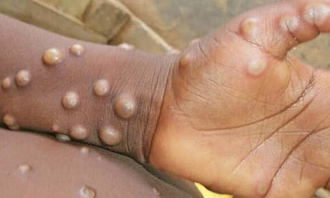 குரங்கு அம்மை நோய்