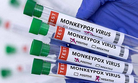 குரங்கு அம்மை 
