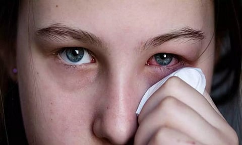 மெட்ராஸ் ஐ: அறிகுறியும்.. தற்காப்பு முறைகளும்..