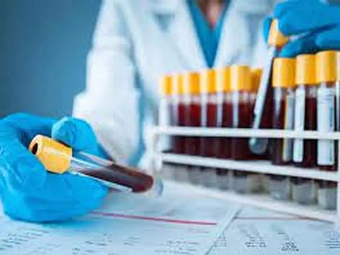 கோவையில் யானைக்கால் பாதிப்பு குறித்து 9,688 பேரின் ரத்த மாதிரி சேகரிப்பு