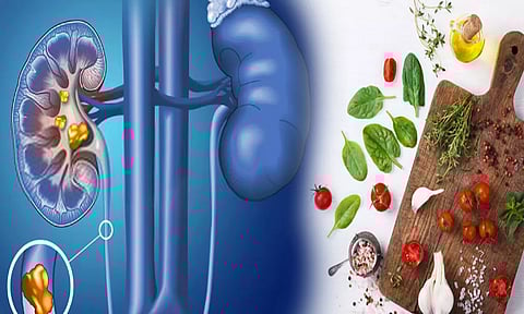 ஆரம்பநிலையில் உள்ள சிறுநீரக கல்... தடுக்கும் சித்த மருந்துகள், உணவுப் பழக்க வழக்கங்கள்