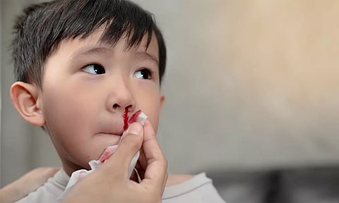 குழந்தைகளுக்கு மூக்கிலிருந்து இரத்தம் வரக்காரணம்...