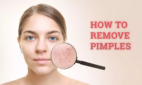 இந்த வாழ்க்கை முறையை பின்பற்றினால் முகப்பரு வராமல் தவிர்க்கலாம்....