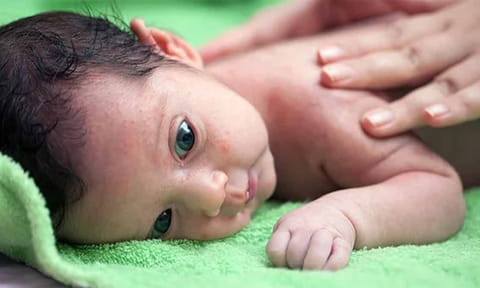 கோடை காலத்தில் குழந்தைக்கு வேர்க்குரு வராமல் தடுக்க பின்பற்ற வேண்டிய வழிமுறைகள்...