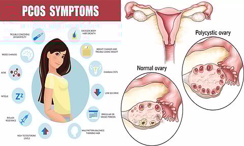 பெண்களை தாக்கும் பி.சி.ஓ.எஸ்... பின்பற்ற வேண்டிய வாழ்க்கை முறை மாற்றங்கள்...