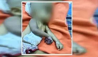 கை அழுகிய விவகாரம்- அறுவை சிகிச்சை செய்து குழந்தையின் கை அகற்றம்