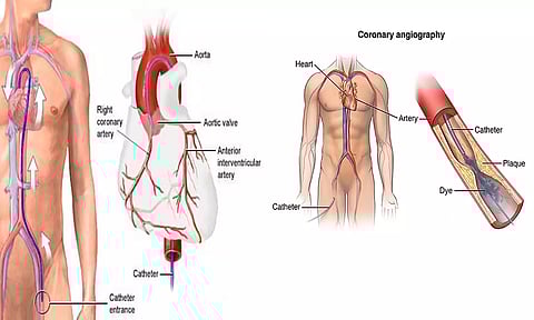இரத்தக்குழாய்களில் அடைப்பு ஏற்பட்டால் ஆஞ்சியோ செய்தால் போதுமா?