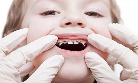 குழந்தைகளுக்கு பல் சிதைவு ஏற்பட இவை தான் காரணம்...