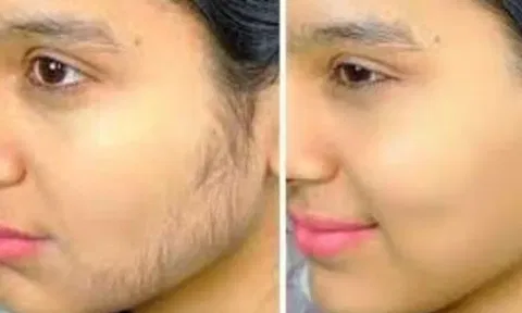 முகத்துல முடி வளருதா? இத பண்ணுங்க...முகம் சைனிங் ஆகிடும்