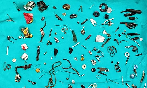 "வயிறா இல்லை வேர்ஹவுஸா?"; நோயாளி வயிற்றில் உலோகங்கள்: அதிர்ந்த மருத்துவர்கள்