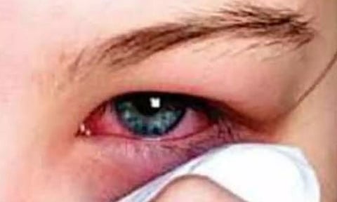 வேகமாக பரவி வரும் `மெட்ராஸ் ஐ' உஷார்...