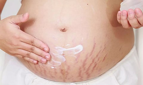 பிரசவ தழும்புகள் மறைய சில குறிப்புகள்