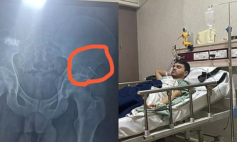 தடுப்பூசி போட்டபோது மாணவரின் இடுப்பில் ஊசி முறிந்து உடலுக்குள் சென்றது: போலீசில் புகார்