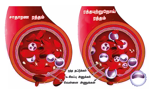 மரபணு மாற்றங்களால் ரத்தபுற்றுநோய் ஏற்படும்...!