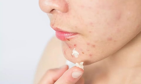 முகத்தில் உள்ள கரும்புள்ளிகள் நீங்க…