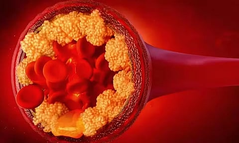 ட்ரை கிளிசரைடு கொழுப்பை கரைக்க என்ன உணவுகளை சாப்பிடலாம்...?