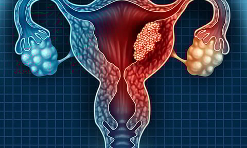 கருப்பை வாய் புற்றுநோயின் அறிகுகள் என்னென்ன...?