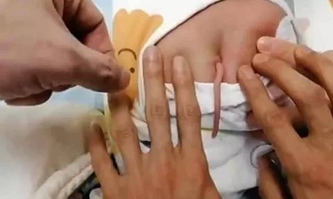 சீனாவில் வாலுடன் பிறந்த ஆண் குழந்தை  - என்ன காரணம்?