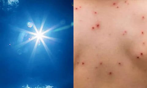 தமிழகத்தில் அம்மை நோய் பரவும் அபாயம்