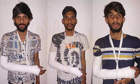 சென்னை: செயின் பறிப்பு வழக்கில் கைதான 3 வடமாநில இளைஞர்களுக்கு எலும்பு முறிவு