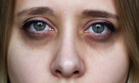 கருவளையத்தை போக்க டாக்டர்கள் கூறும் சிறந்த அட்வைஸ்!