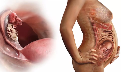 கருப்பையில் நீர்கட்டி இருந்தால் கருத்தரிப்பதில் சிக்கல் உண்டாகுமா?