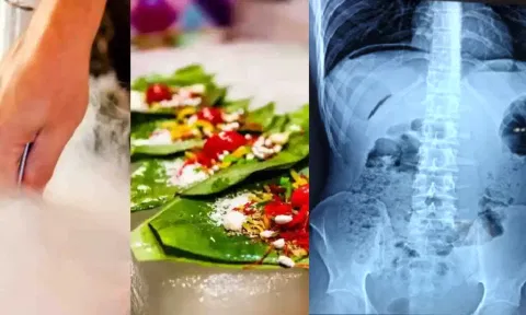 திரவ நைட்ரஜன் பான் சாப்பிட்ட சிறுமியின் வயிற்றில் விழுந்த ஓட்டை.. அதிர்ச்சி!