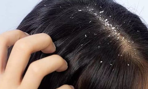 பொடுகுத்தொல்லையில் இருந்து விடுபட சிறந்த வழி