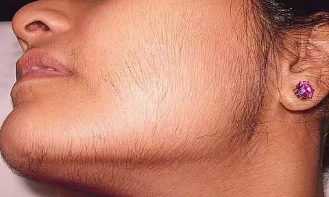 முகத்தில் உள்ள முடிகளை போக்க இதை ட்ரை பண்ணுங்க!