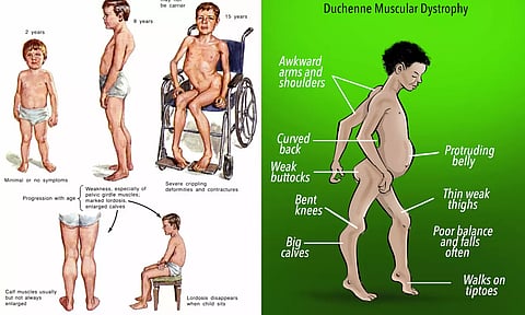 தசைவாதம் என்றால் என்ன? அதற்கான சித்தமருத்துவ தீர்வு