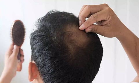 ஆண்கள் முடி உதிர்வில் இருந்து தப்பிக்க ஒரு சில வழிமுறைகள்...