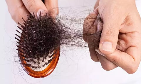 முடி உதிர்வை தடுப்பது எப்படி?