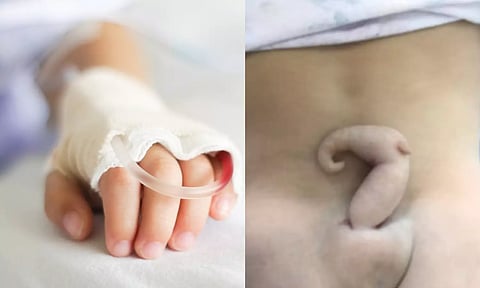 3 மாத குழந்தையின் முதுகில் 15 செ.மீ. நீள வாலை அகற்றி மருத்துவர்கள் சாதனை