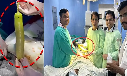 வாலிபர் வயிற்றில் ஒரு அடி நீள சுரைக்காய்: ஆபரேசன் மூலம் நீக்கம்