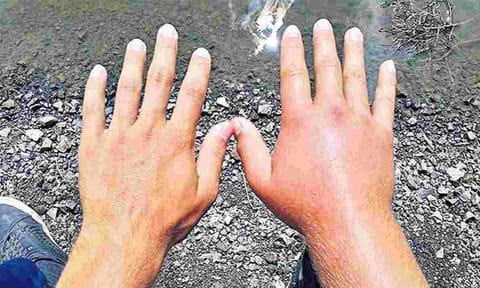 ஆந்திராவில் கை, கால் வீக்கத்துடன் புதுவகை காய்ச்சல் உஷார்....