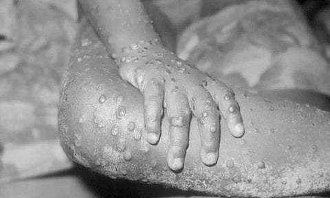 குரங்கம்மை: அதிகரிக்கும் உயிரிழப்புகள்... சர்வதேச சுகாதார அவசரநிலையை பிறப்பித்த உலக சுகாதார அமைப்பு