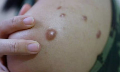 தெரிந்து கொள்வோமா... குரங்கம்மை நோயின் அறிகுறிகள்