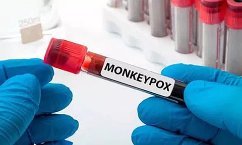 குரங்கம்மை தடுப்பு- மாநிலங்களுக்கு மத்திய அமைச்சகம் கடிதம்