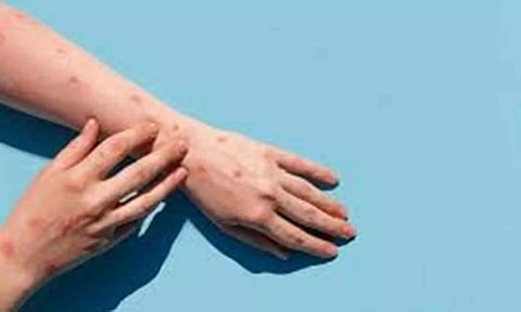 குரங்கம்மை அறிகுறியுடன் ஆஸ்பத்திரியில் வாலிபர் அனுமதி