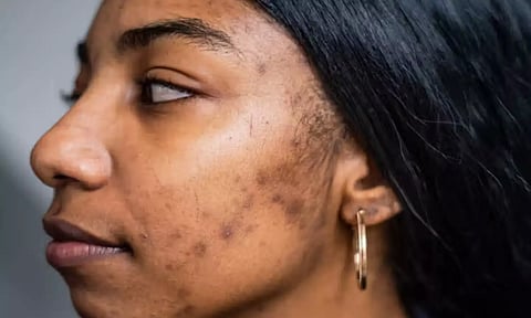 முக அழகை கெடுக்கும் கரும்புள்ளிகள், தழும்புகள் மறைய சில டிப்ஸ்