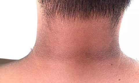 கழுத்து கருமையை நீக்க உதவும் டிப்ஸ்