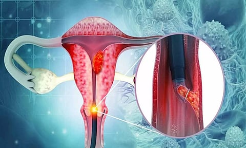 கருப்பை வாய் புற்றுநோய் என்றால் என்ன.... அதன் அறிகுறிகள்?