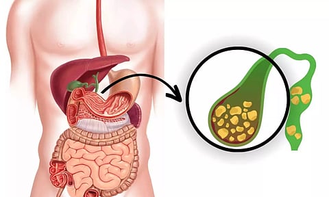 பித்தப்பை கல் என்றால் என்ன...? இயற்கை வழியில் அகற்றுவது எப்படி?