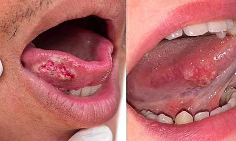 நாக்கு புற்றுநோயின் அறிகுறிகள்