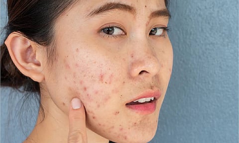 சரும துளைகள் மற்றும் கரும்புள்ளிகள் ஏற்பட என்ன காரணம்? தவிர்ப்பது எப்படி?