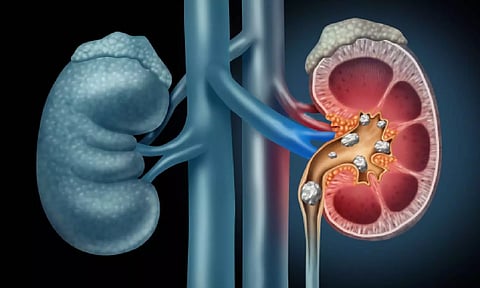 சிறுநீரக கற்கள் எதனால் உருவாகின்றன? எப்படி தடுப்பது?