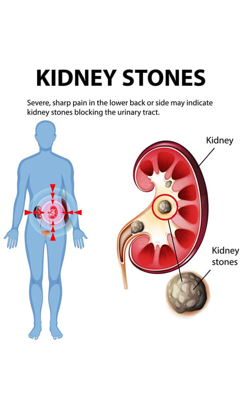 சிறுநீரக கற்கள் எதனால் உருவாகின்றன? எப்படி தடுப்பது?