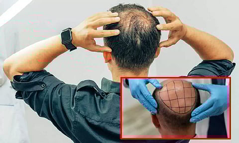 முடி மாற்று அறுவை சிகிச்சை செய்த பல் மருத்துவர் - 2 பேர் உயிரிழப்பு