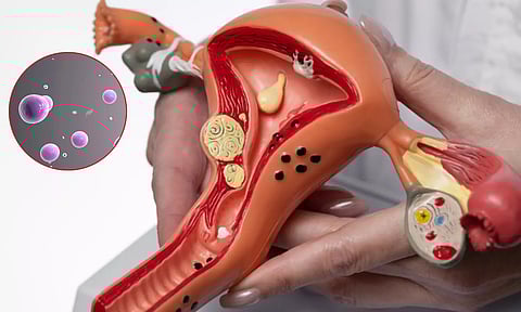 பெண்களுக்கு தொல்லை கொடுக்கும் பூஞ்சை தொற்றும், தடுக்கும் முறையும்...!