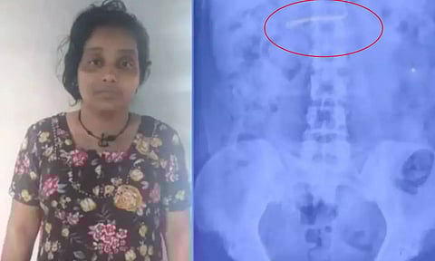 மருத்துவமனையில் நகையை திருடி வாயில்போட்டுக்கொண்ட பெண்... எக்ஸ்ரே மூலம் கண்டறிந்த போலீசார்!